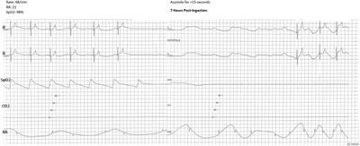Asystole in a young child with tetrahydrocannabinol overdose: a case report and review of literature